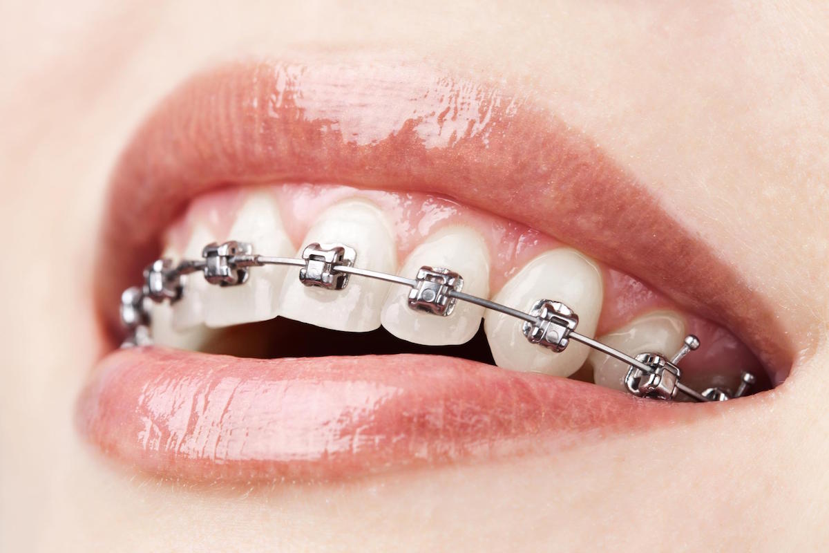 brace retainers leederville