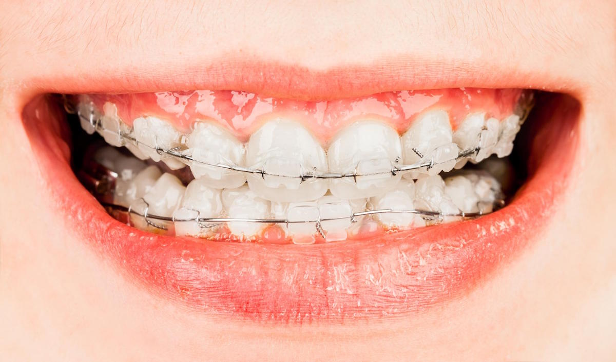 ceramic braces leederville