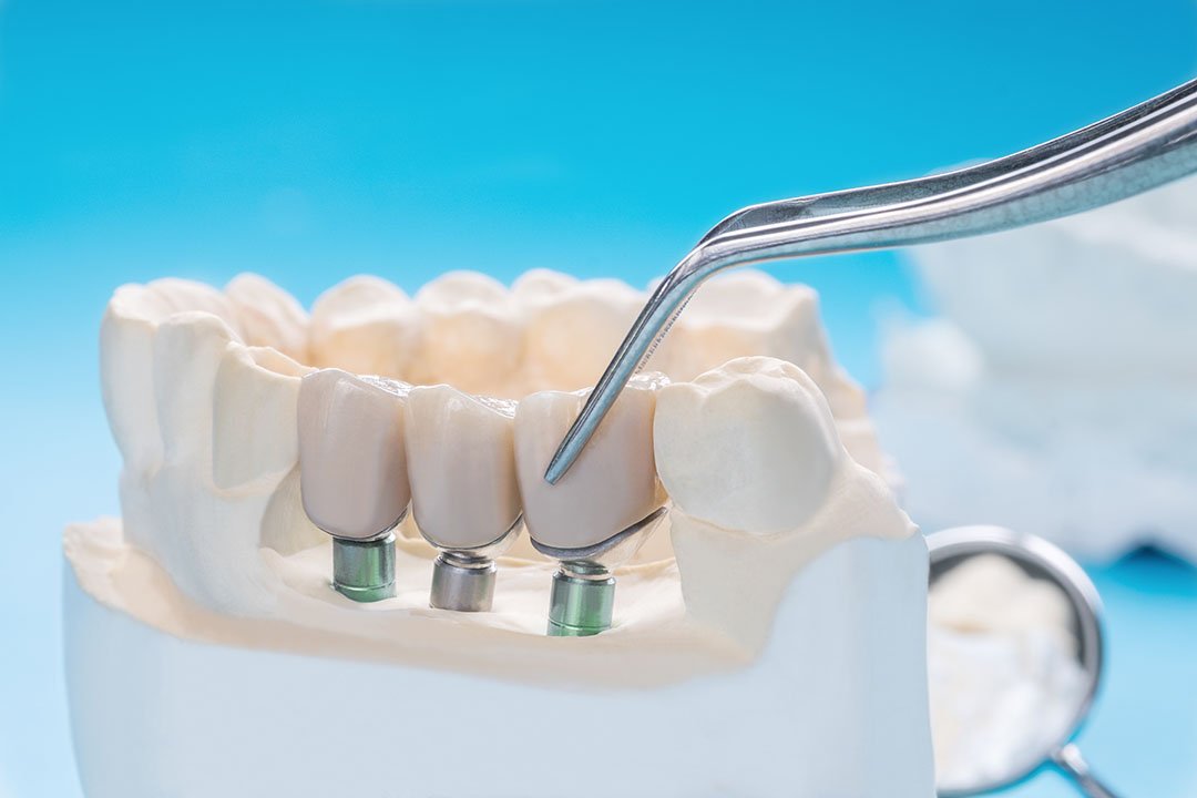 Close up implant and prosthodontic model.