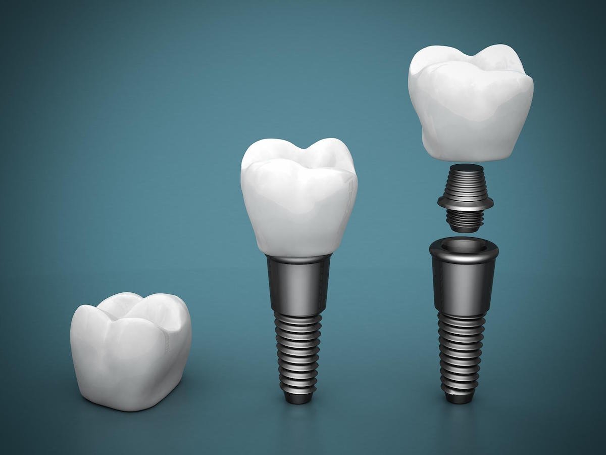 dental implants leederville