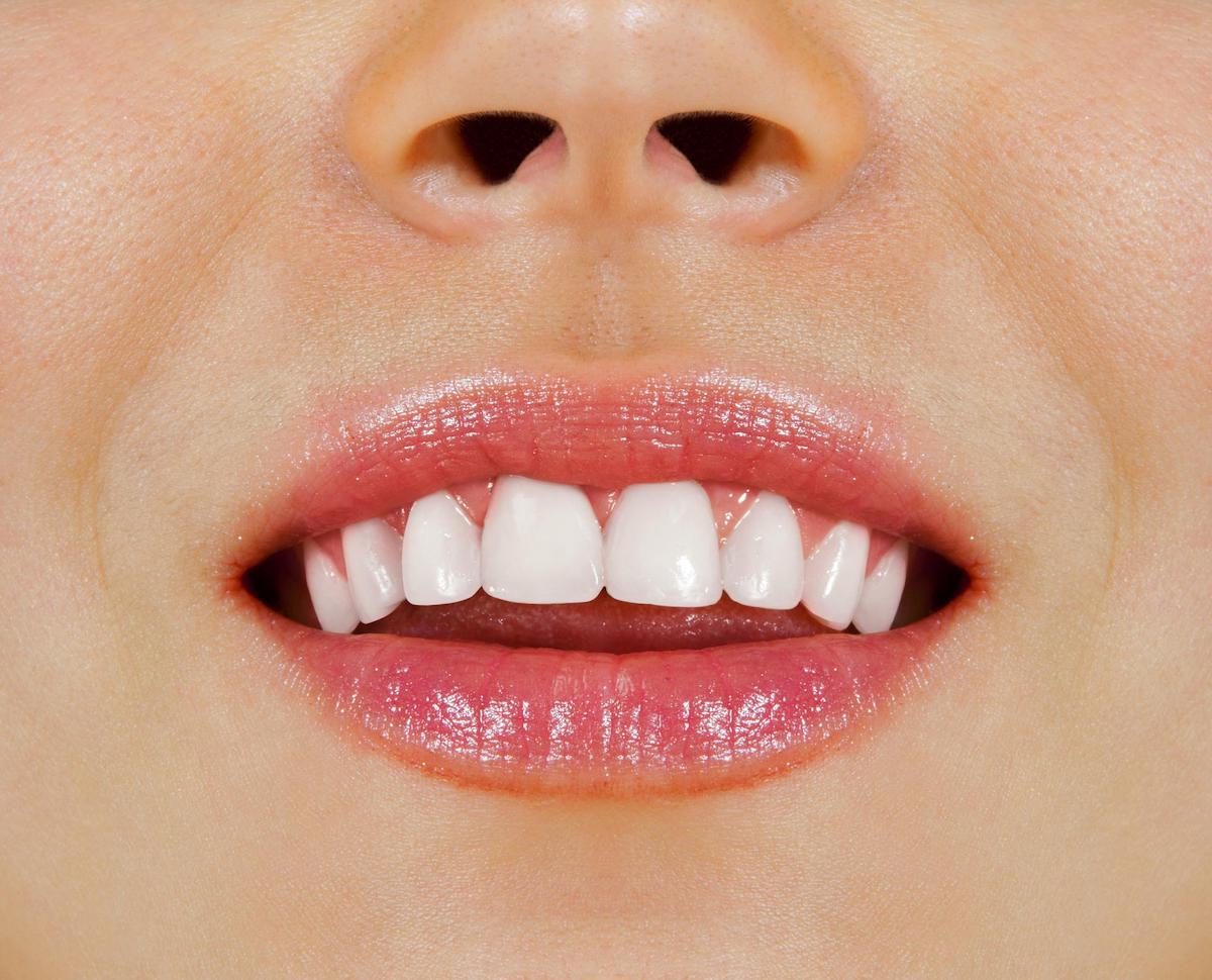 internal teeth bleaching after care leederville