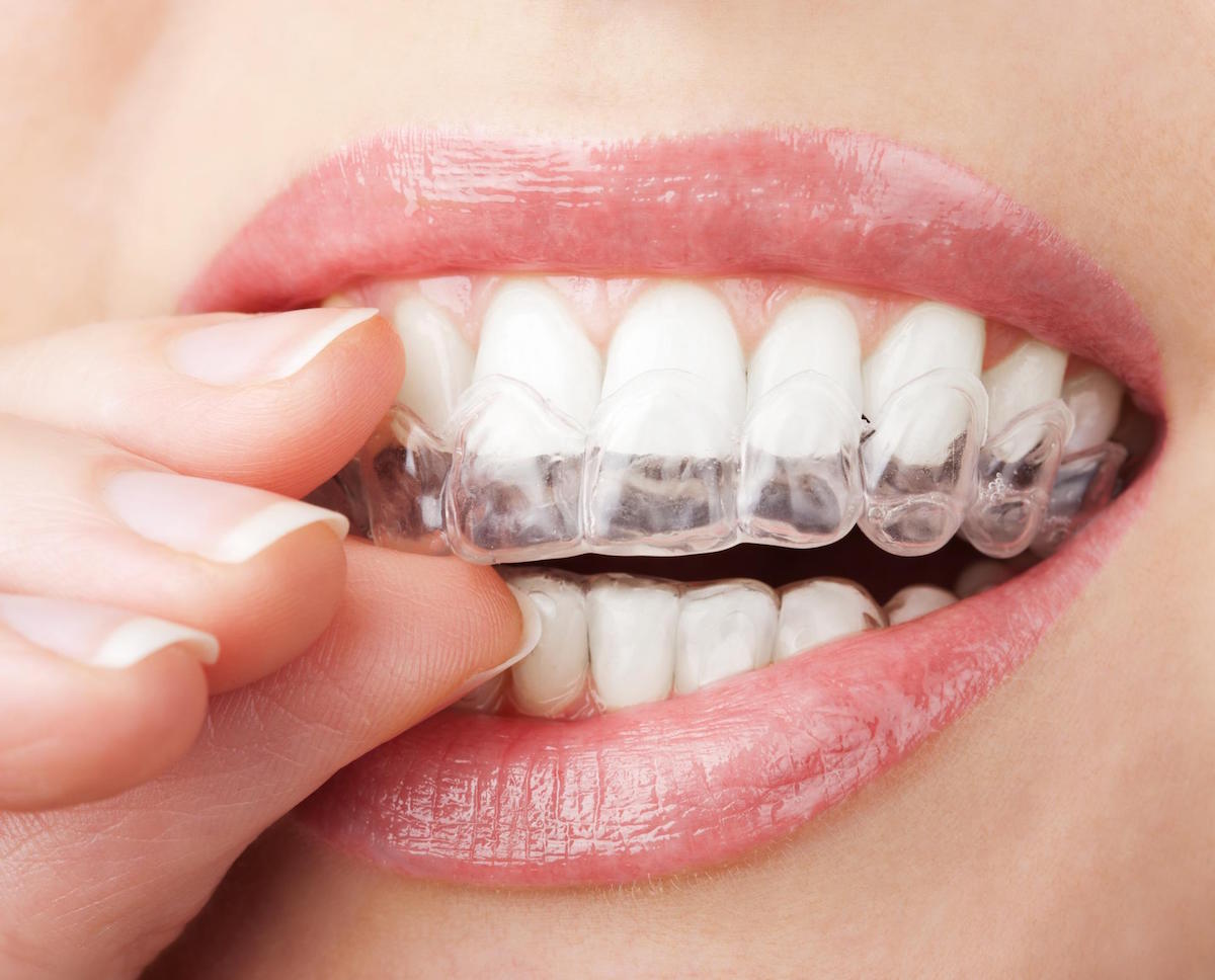 invisalign leederville