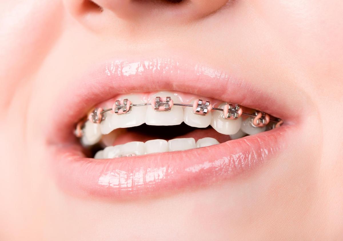 orthodontics leederville