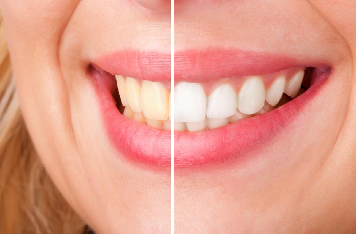 teeth whitening leederville