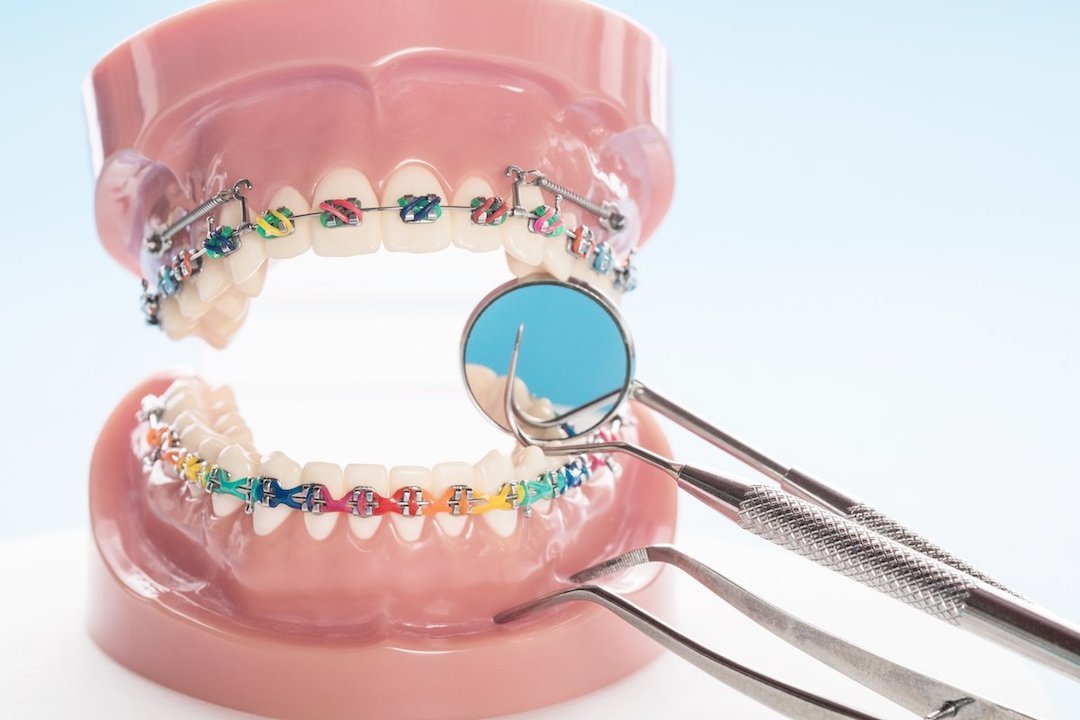 types of orthodontic treatment leederville