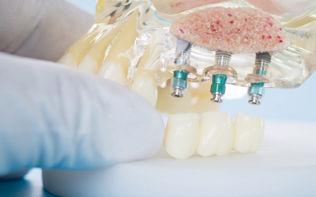 what can i expect after receiving a dental implant leederville