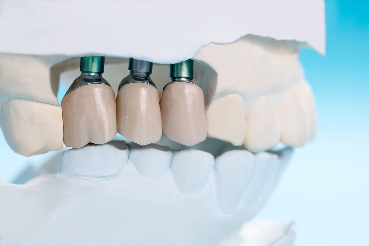 what is dental crown leederville