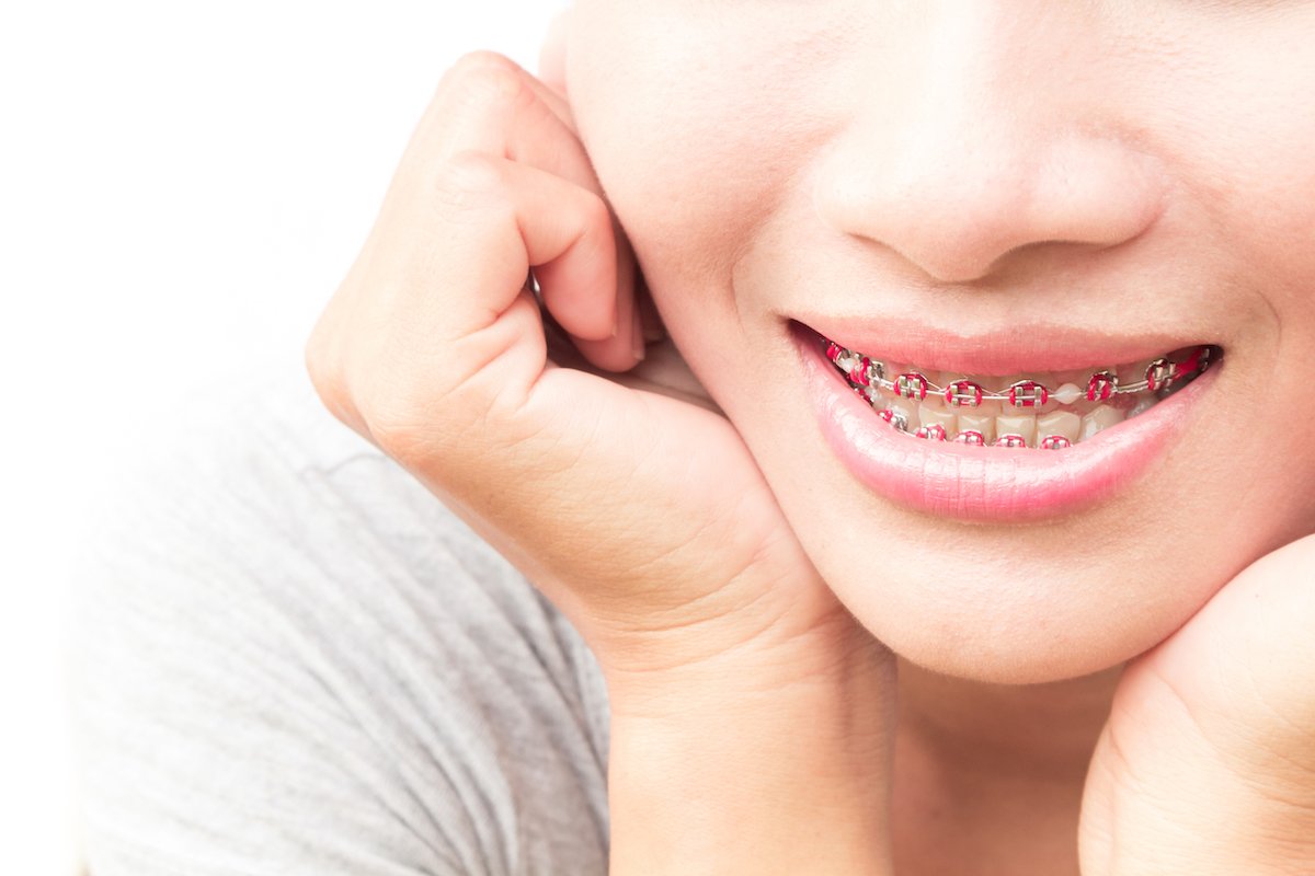 invisalign leederville