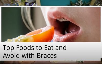 Top Foods to Eat and Avoid with Braces from Dentists on Vincent