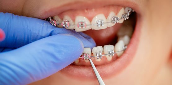 braces-care-leederville