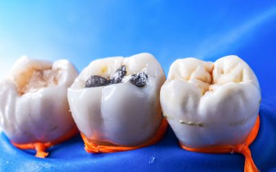 Picking the Right Type of Dental Fillings in Leederville