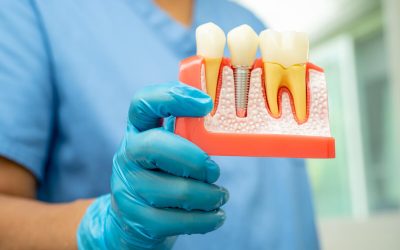 Are Dental Implants Painful? What to Expect