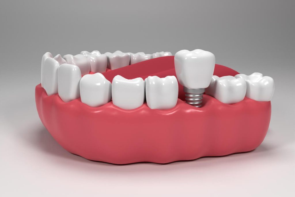 caring for your dental crown tips for longevity and maintenance