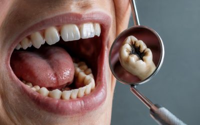 Tooth Decay Stages: What’s Happening Inside Your Teeth (And How to Stop It)
