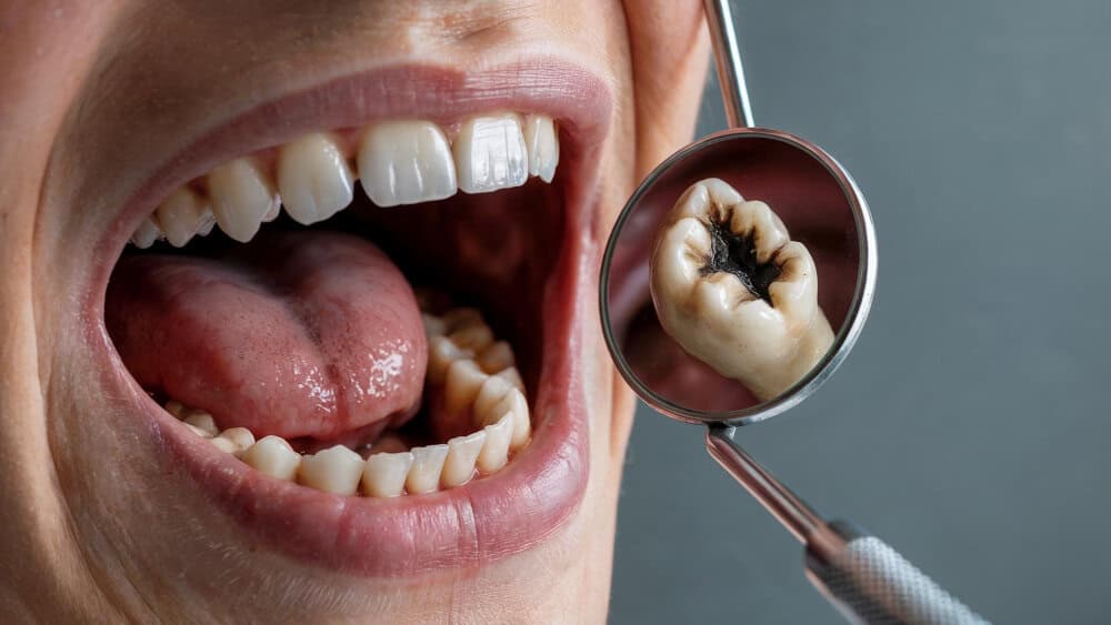 Tooth Decay Stages What's Happening Inside Your Teeth (And How to Stop It)